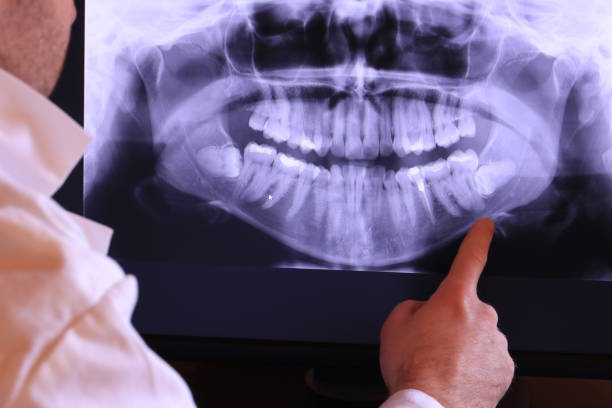 Best Emergency Wisdom Teeth Removal in Ben Wheeler, TX